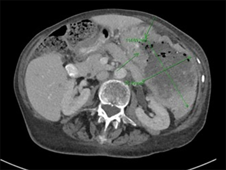 Figure 2. Large 11.5x7.6cm splenic mass with heterogeneous areas of air-containing parenchyma indicating necrosis