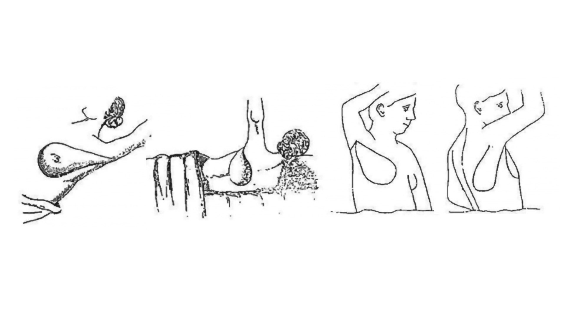 The History of Breast Reconstruction Is a Journey of Resilience