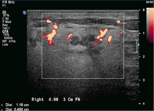 B) Blood flow within and surrounding mass