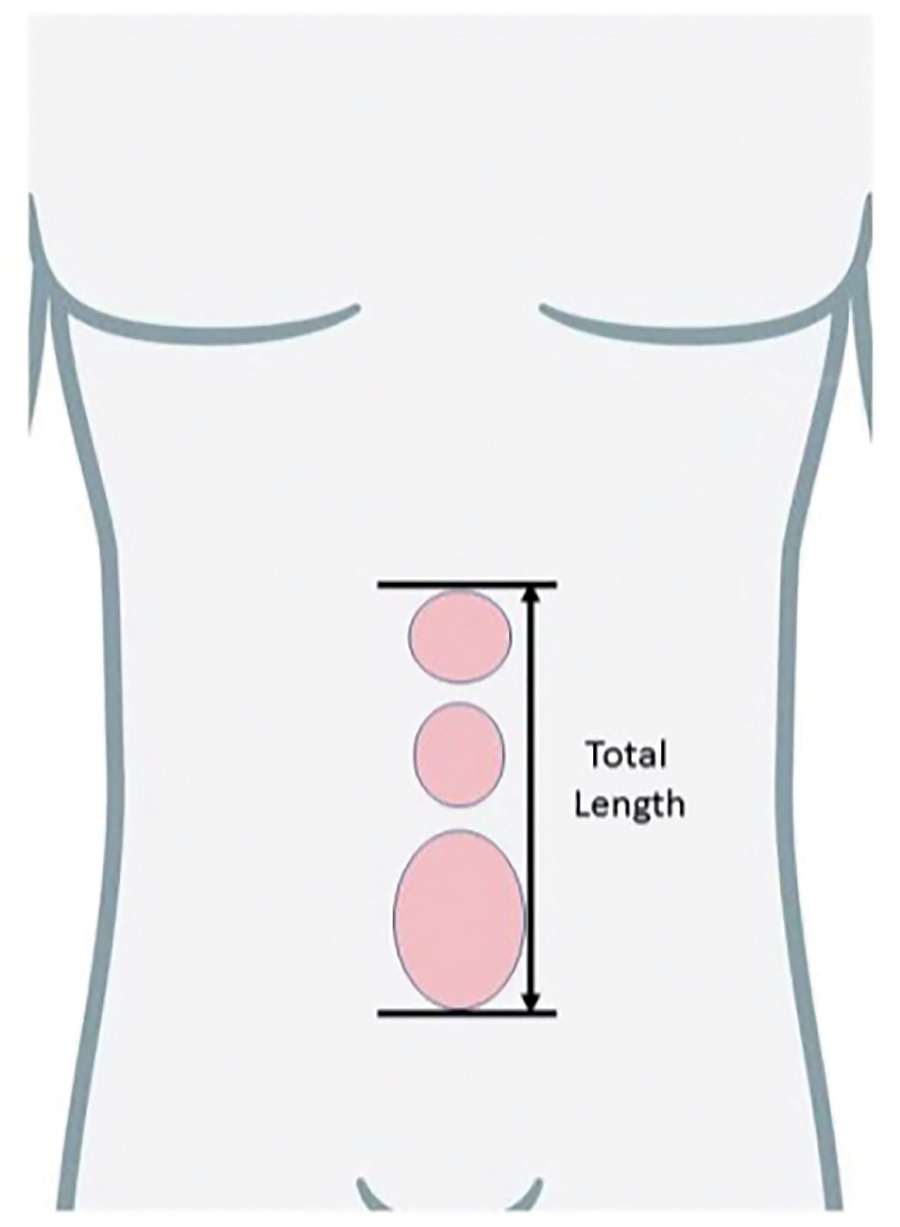 Coming in 2023 Extensive Changes for Reporting Anterior Abdominal