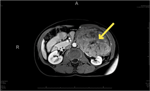 B) Image depicting with intravenous contrast