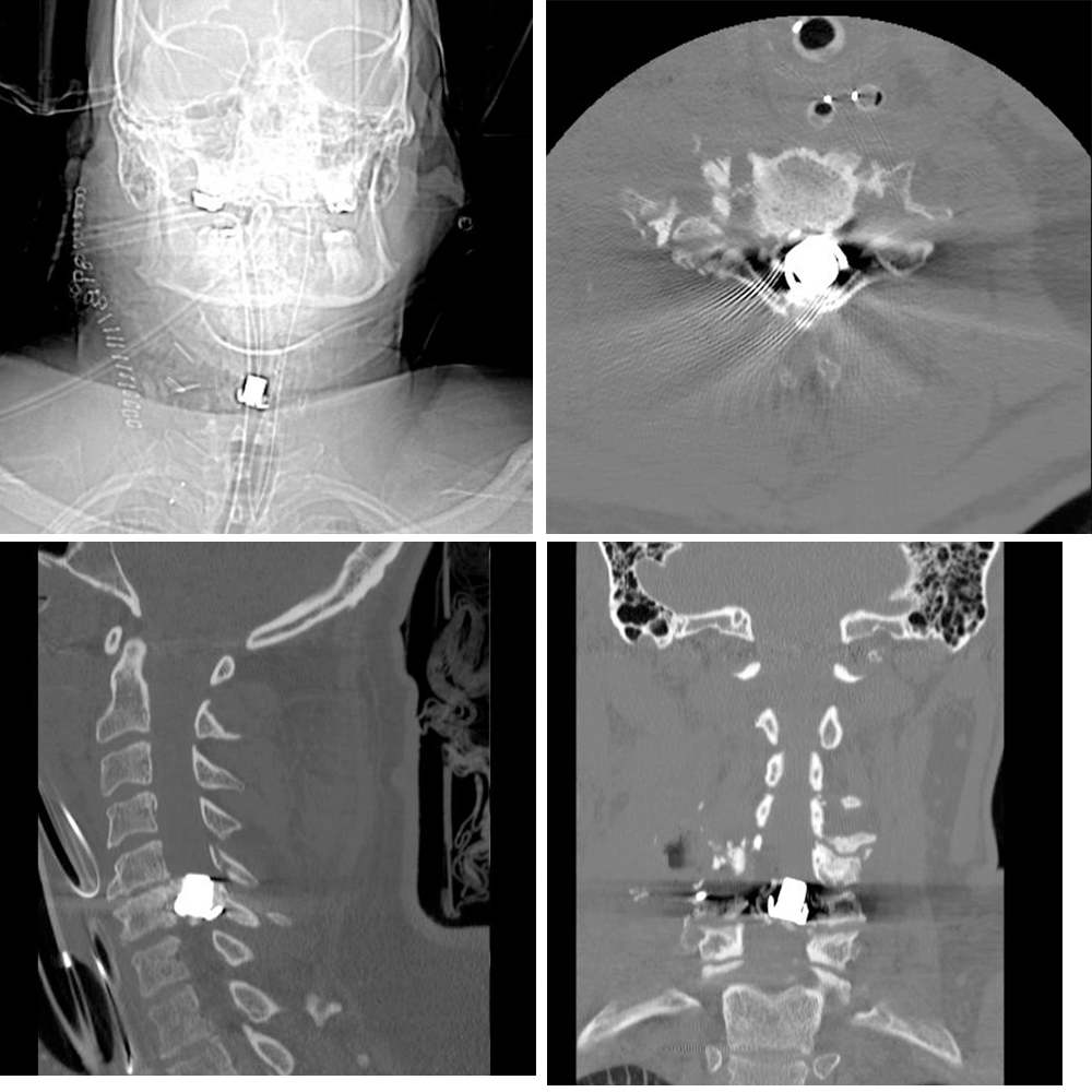 C7 non-displaced fracture, extensive comminuted fracture of C6 vertebra, and fracture of right lateral aspect of C5 vertebra involving C4 right transverse process and foramen.