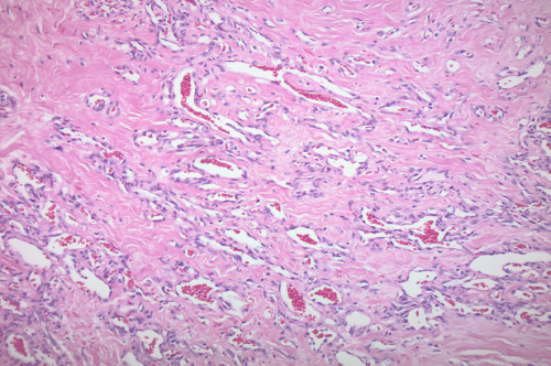 B) 10X: H&E stain demonstrating anastomosing vessels