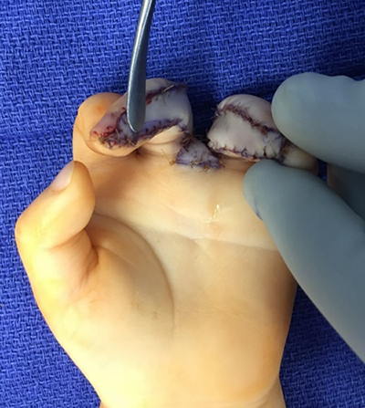 Figure 4. Immediate postoperative picture showing the full thickness skin grafts.