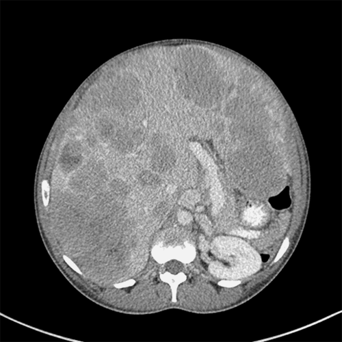 Large, space-occupying tumor causing compression of the vena cava and a significant right-sided pleural effusion