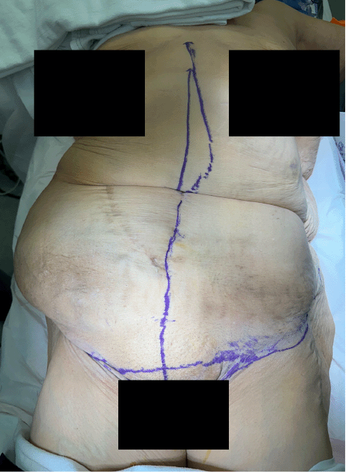 Preoperative clinical photograph of the patient’s abdomen, demonstrating the large, right-sided incisional hernia and significant pannus