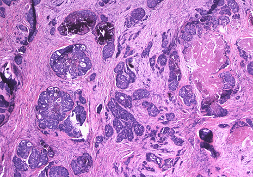 (A) H&E stain (40x magnification) demonstrating the infiltrating tumor cells with a nested and cribriform architecture, patchy tumor necrosis, and calcifications