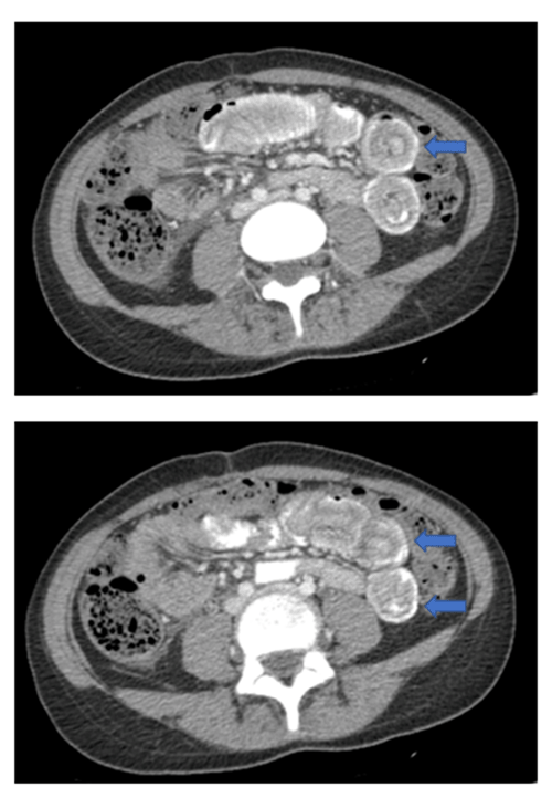 CT Scan of Abdomen with IV and Oral Contrast, Suggestive of Three Distinct Areas of Intussusception within Small Intestine (blue arrows). 