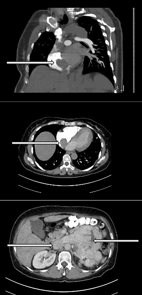 Figure 2: Computed tomography of the chest and abdomen demonstrating a tumor extending into the inferior vena cava and the right atrium. (A) Coronal view of intracardiac tumor (arrow) (B) Axial view of the intracardiac tumor (arrow) (C) Axial view of the left adrenal mass with tumor extension into the left renal vein and IVC (arrows)