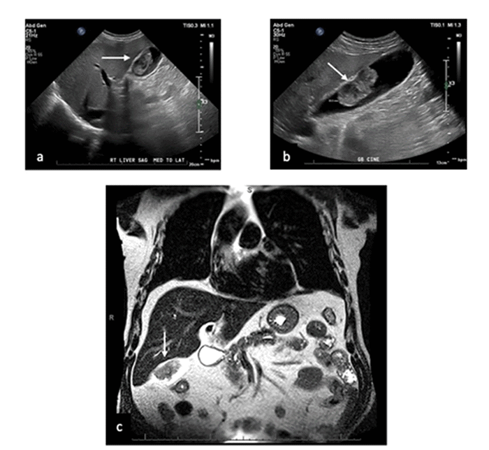 Metastatic Melanoma of the Gallbladder | ACS Metastatic Melanoma of the Gallbladder | ACS