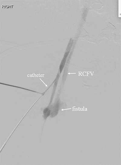 Figure 4. Right sided AVF. Catheter seen inserted into femoral artery for retrograde contrast injection, with fistula visualized and opacification of the venous system, with no flow in the distal artery. RCFV=right common femoral vein.