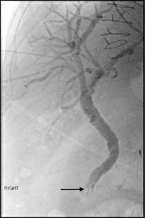 Linear density embedded in filling defect compatible with metal clip/stone complex seen in distal common bile duct, commonly termed “cat’s eye calculi” (arrow).