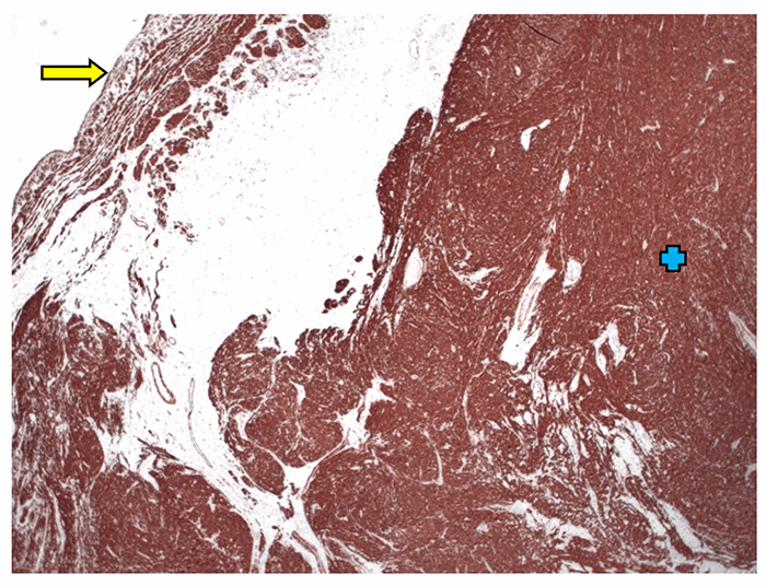 Figure 3. A: Histology of the leiomyosarcoma arising from the great saphenous vein staining positive for desmin (pictured) and caldesmin. Vessel wall marked with yellow arrow with the sarcoma extending radially and marked by blue +.