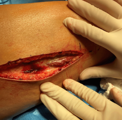 Intraoperative photograph demonstrating bulging of the vastus lateralis muscle following fasciotomy of the right anterior thigh compartment, indicative of significant compartment pressure