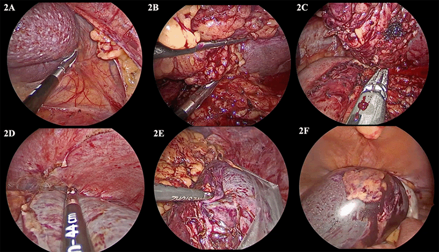 A) Dissection was carried out along splenocolic and splenorenal ligaments using Ligasure following complete dissection of gastrosplenic ligament. B & C) The spleen was retracted superiorly, and dissection was carried out around splenic hilum; Endo GIA 60-mm articulating stapler was used to divide the hilum completely. D) Spleen was dissected from diaphragm; and E & F) specimen was retrieved with Endo Catch™ bag and removed intact through mini-Pfannenstiel incision. 