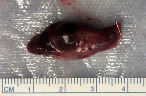 Operative findings were identical to those predicted by scan.