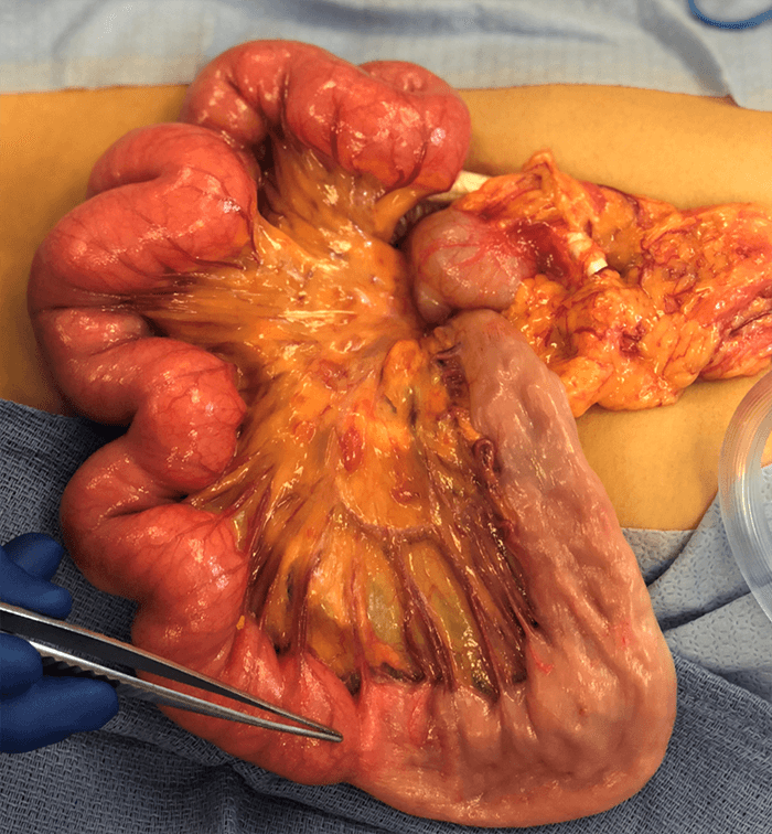 Figure 2. Intraoperative Photograph of Mid-Jejunal Stricture. The stricture was found mid-jejunum with stippling on the serosal surface at the location of the stricture (inlay).