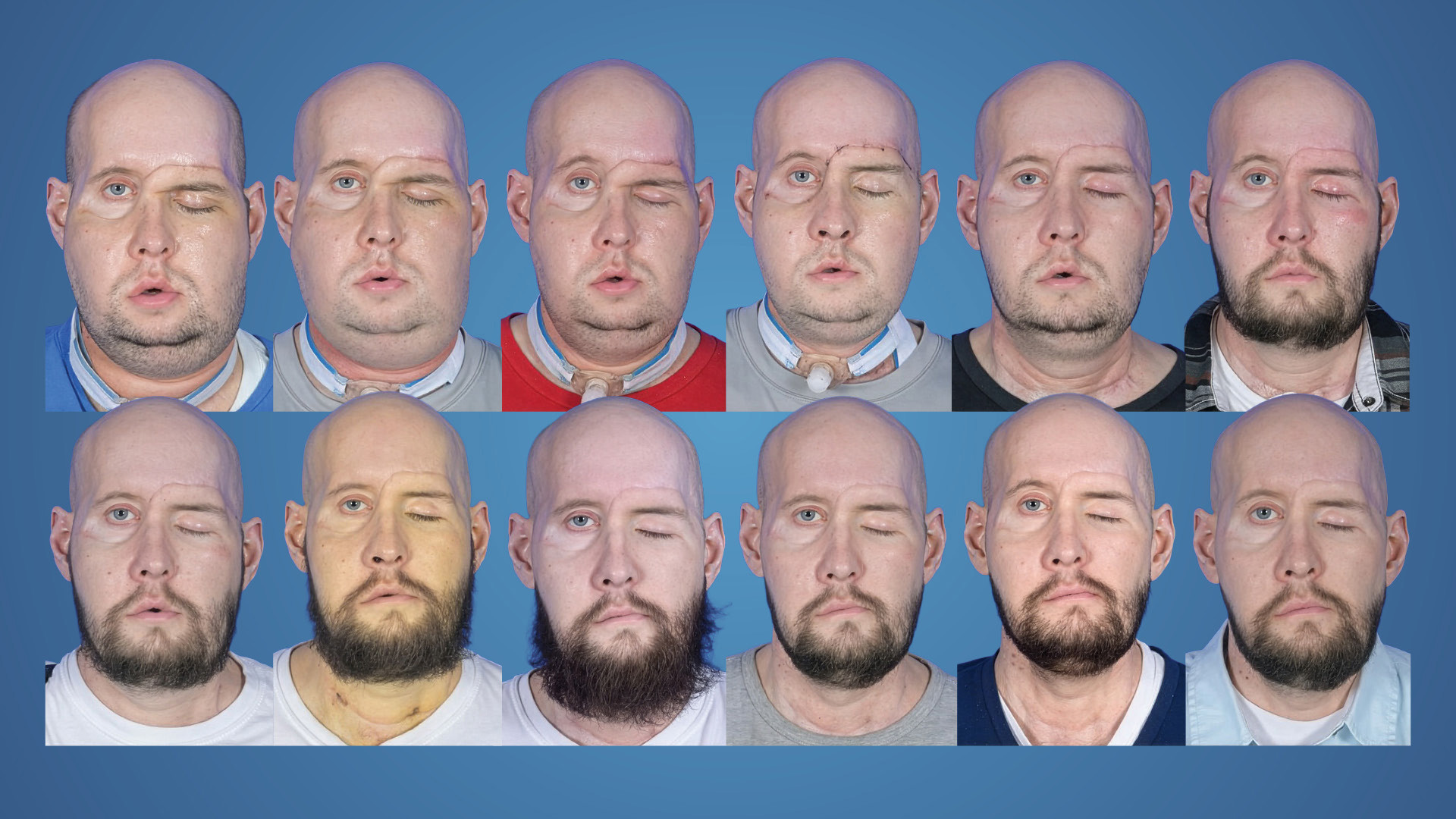 Facial Transplantation Pushes Beyond Limits of Reconstruction