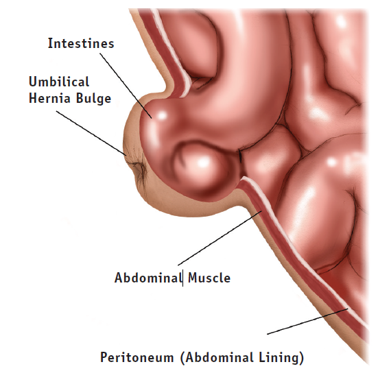 Pediatric Umbilical Hernia Repair