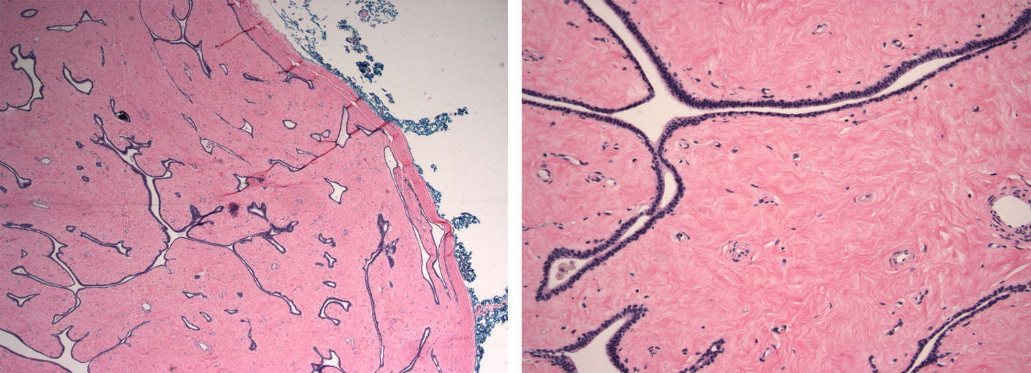 Figures 1 C and D: Low-power and high-power slides from a fibroadenoma in 2015