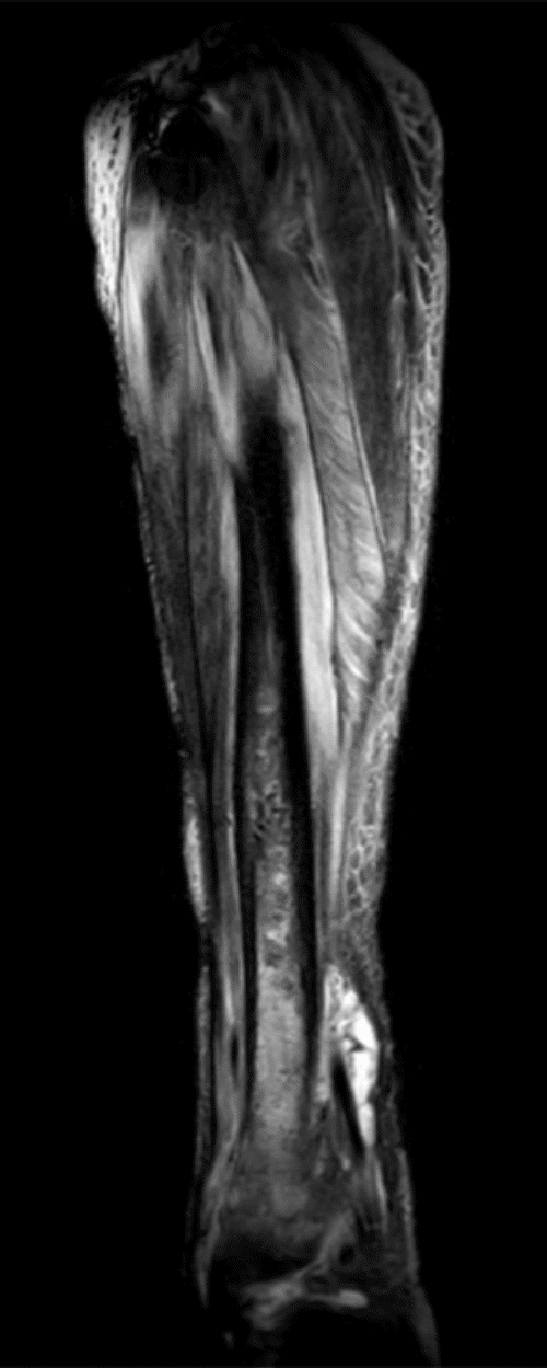C) Coronal STIR MRI showing distal tibial bone marrow edema and extensive intramuscular and subcutaneous edema