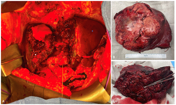 Intraoperative images following resection of segments 4A, 4B, 5, 7, and 8: (A) Preserved segment 6 (white asterisk) and left lateral section (blue asterisk). (B) Resected specimen. (C) Instrument indicating the segment 7 pedicle within the specimen