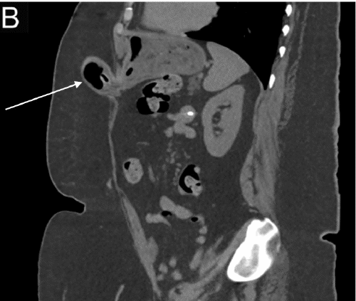 B) Sagittal view demonstrating gastric hernia (arrow)