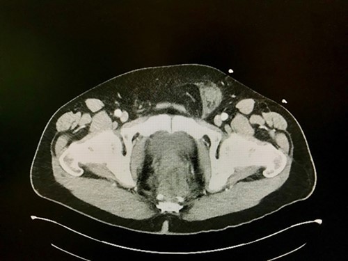 Figure 3. CT scan revealing incarcerated left inguinal hernia with tissue stranding.
