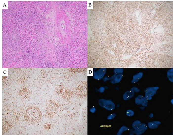 (A) Spindled area of the mass, H&E stain, 40x magnification. (B) ALK1 immunohistochemical stain in the spindled area, 40x magnification. (C) ALK1 immunohistochemical stain demonstrating positivity both within and outside the follicles, 40x magnification. (D) Fluorescence in situ hybridization (FISH) using an ALK break-apart probe, demonstrating separate red and green signals in multiple cells, consistent with ALK rearrangement. A yellow fusion signal indicates the normal, non-rearranged ALK copy.