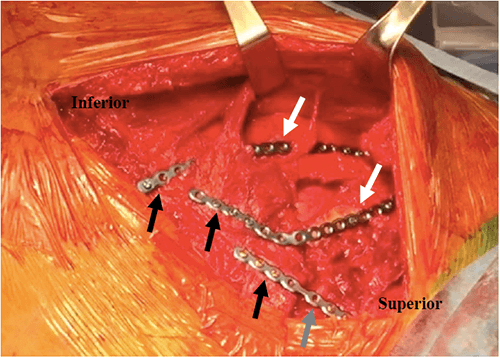 Figure 4: Open sternotomy with right pectoralis major muscle dissected displaying anterior titanium plating. The black arrows depict plates anchored to the sternum, gray depicts the plated manubrium, and white arrows show titanium plate on right ribs 2 and 3. These resulted in successful ORIF of the manubriosternal angle and right ribs 2 and 3 to the sternum.