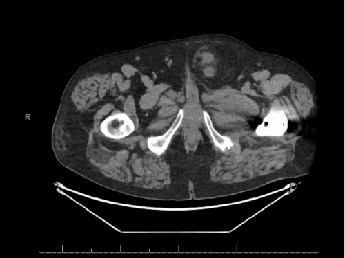 Axial view showing the incarcerated and hydronephrotic distal left ureter contained within the left inguinal hernia sac