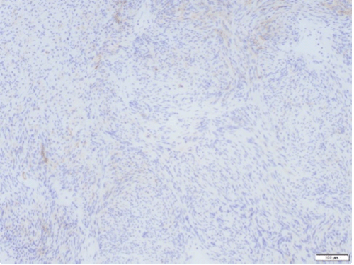 c-KIT negativity C) excludes diagnosis of gastrointestinal stromal tumor (GIST)—images B and C shown at 10x magnification