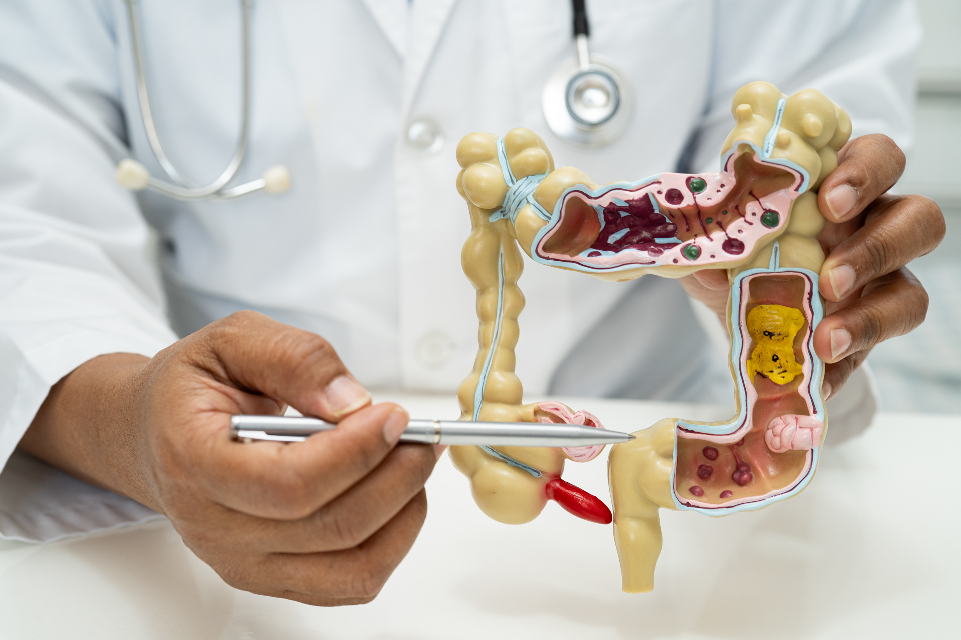 Appendectomy for Appendicitis Associated with 58% Lower Colorectal Cancer Risk Than Antibiotics Alone 