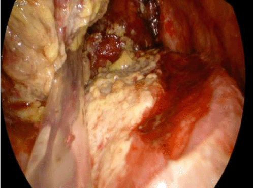 Note the presence of a thick, fibrinous peel and purulent material consistent with a loculated empyema within the left pleural cavity, necessitating decortication