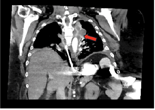 Image demonstrates near-complete resolution of the large pleural effusion, with a small, residual loculated fluid collection (arrow) noted in the apex of the left lung, superior to the pulmonary hilum