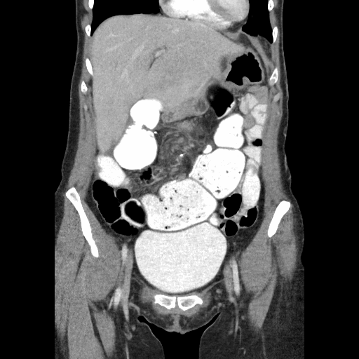 Recurrent Ileal J Pouch Volvulus ACS