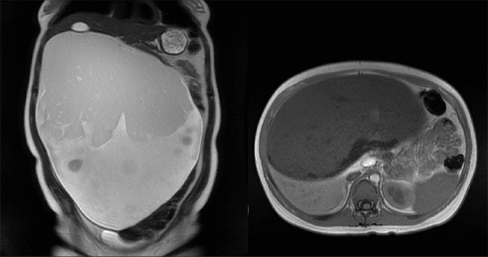 Large (32.5 x 28.1 x 14.1 cm) retroperitoneal mass with both cystic and solid components containing internal fat