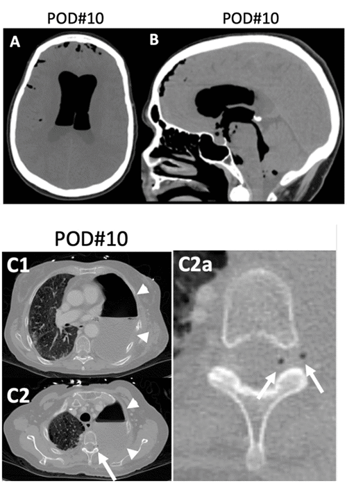A, B: Axial and sagittal head CT scans demonstrate extensive intraventricular and subarachnoid air (pneumocephalus). C1, C2: Axial chest CT scans on the same day reveal an air- and fluid-filled left thoracic cavity post-pneumonectomy (arrowheads). C2 (white arrow): Punctate air foci within the left T2/T3 foramina and the spinal canal indicate a subarachnoid-pleural fistula. This is magnified in the inset (C2a, white arrows)