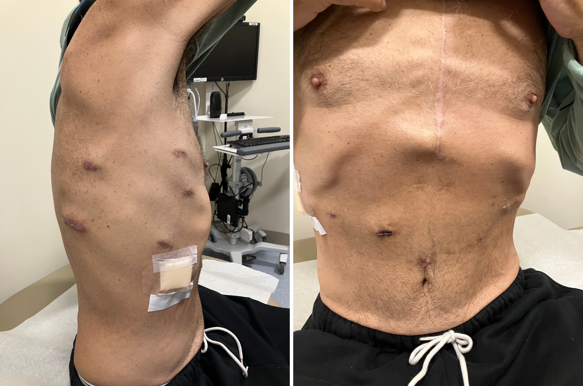 This patient underwent a minimally invasive esophagectomy, which required a series of small incisions in the abdomen and chest.
