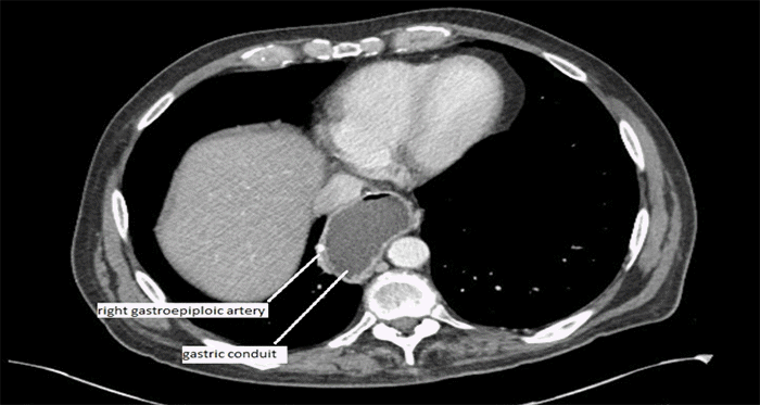Gastric conduit vascularized by the right gastroepiploic artery