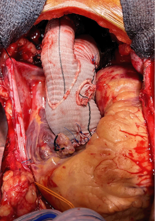 Completed repair with replacement of the ascending aorta and Zone 2 aortic arch using a single-limb graft anastomosed to the patient's bovine arch configuration