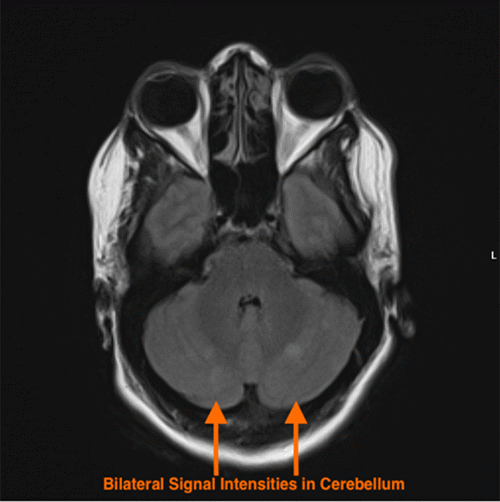 The image shows multiple, small, punctate foci of high signal intensity (arrows) distributed throughout bilateral cerebellar hemispheres, characteristic of acute embolic infarcts