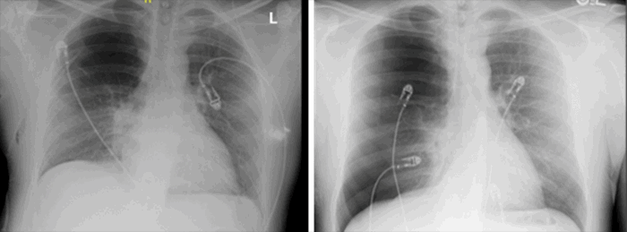 The Big Hit of Vape That Led to a Pneumothorax | ACS The Big Hit of Vape That Led to a Pneumothorax | ACS