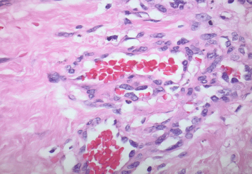 C) 40x: H&E stain demonstrating endothelial atypia