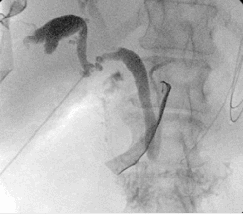 A) IOC reveals a choledochal cyst (CDC) arising from the right side of the common bile duct (CBD) and draining directly into the cystic duct (CD)