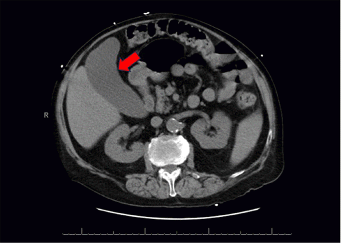 Axial view from a CT scan of the abdomen obtained during a prior admission. Note significant gallbladder distension (hydrops, red arrow), without evidence of cholelithiasis or pericholecystic inflammatory changes at that time