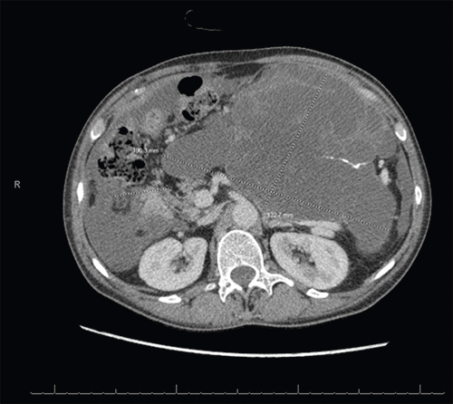 Axial contrast-enhanced CT of the pancreas. The image demonstrates the interface of the large cystic neoplasm with the more proximal pancreas. A small amount of preserved pancreatic parenchyma is noted at the level of the pancreatic neck, demarcating the proximal extent of the tumor’s involvement