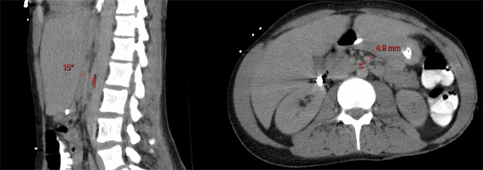 Image shows compression of the third part of the duodenum between SMA and the aorta. Reduced aortomesenteric angle (red) and distance confirm SMA syndrome