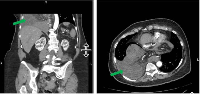 bpc 157 hiatal hernia A Catastrophic Complication: Strangulated Hiatal Hernia with Necrotic Roux Limb After RYGB