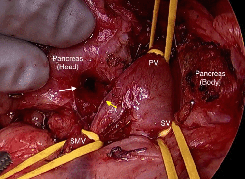 Image demonstrates the fistula from the pancreatic margin (white arrow) and the repaired fistula (yellow arrow).